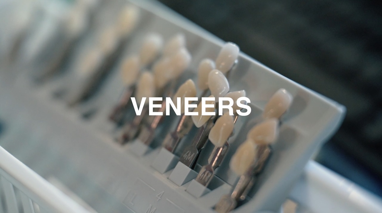 Veneers Thumbnail
